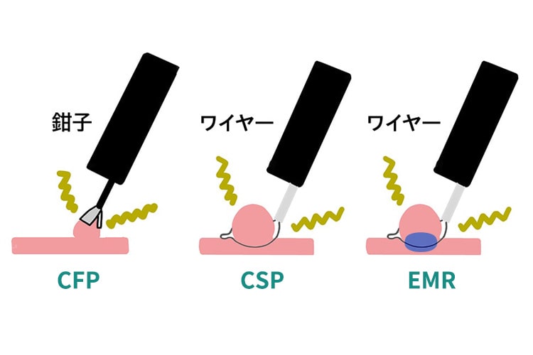ポリープ切除方法